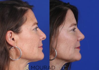 Rhinoplasty & Female Rhinoplasty