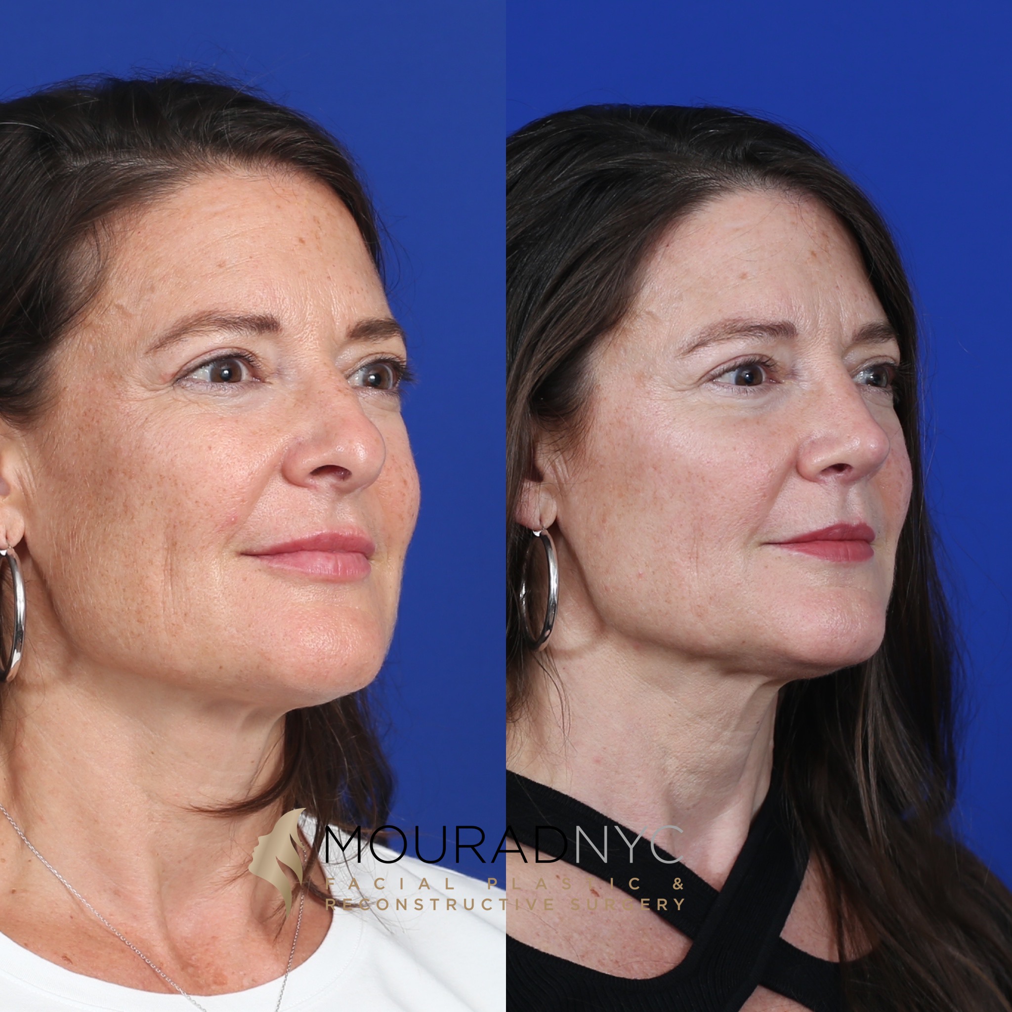 MC5 Rhinoplasty & Female Rhinoplasty