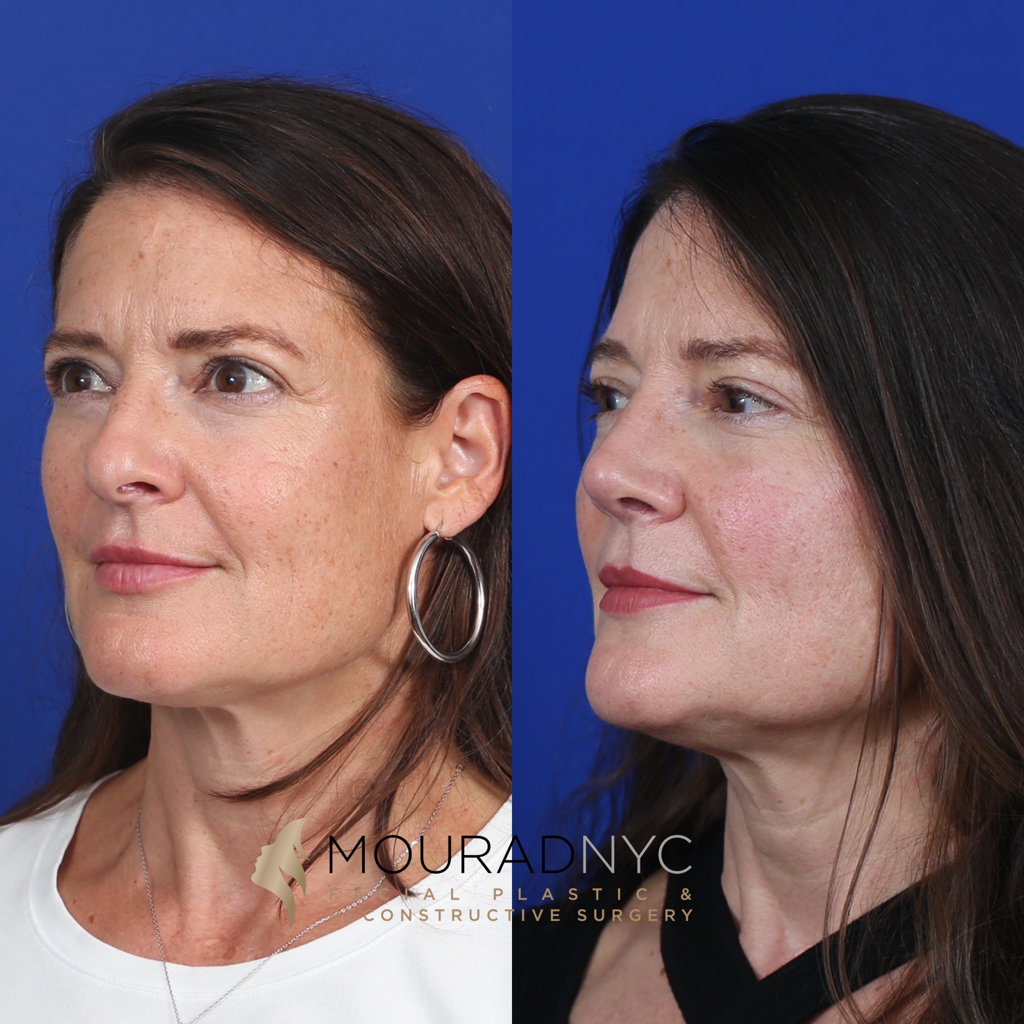 MC6 Rhinoplasty & Female Rhinoplasty