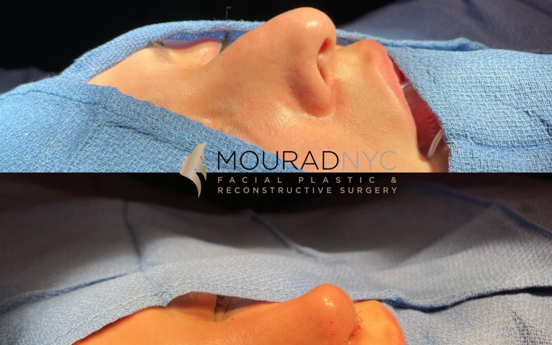 Rhinoplasty & Female Rhinoplasty