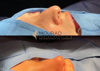 Rhinoplasty & Female Rhinoplasty