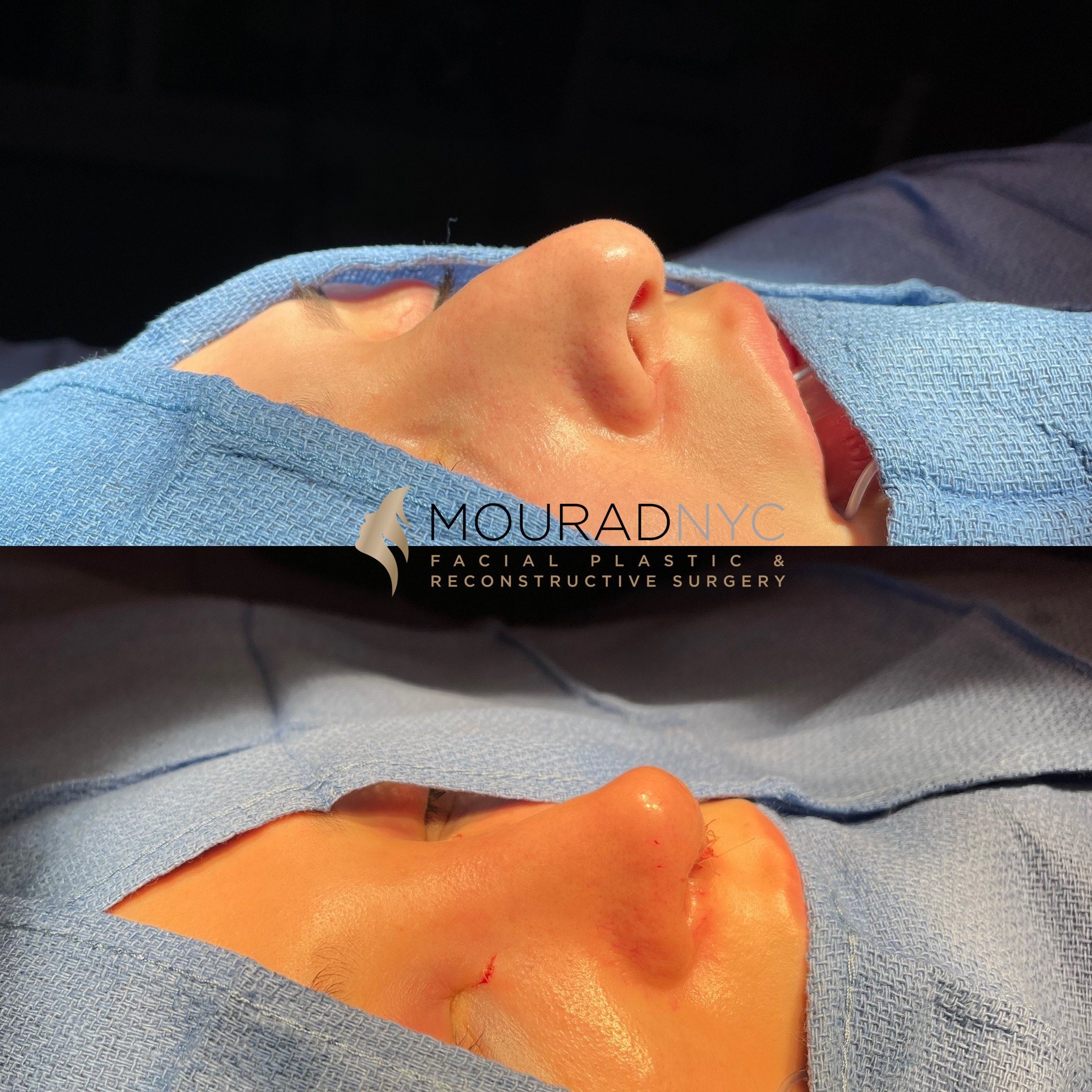 On Table 1 Rhinoplasty & Female Rhinoplasty