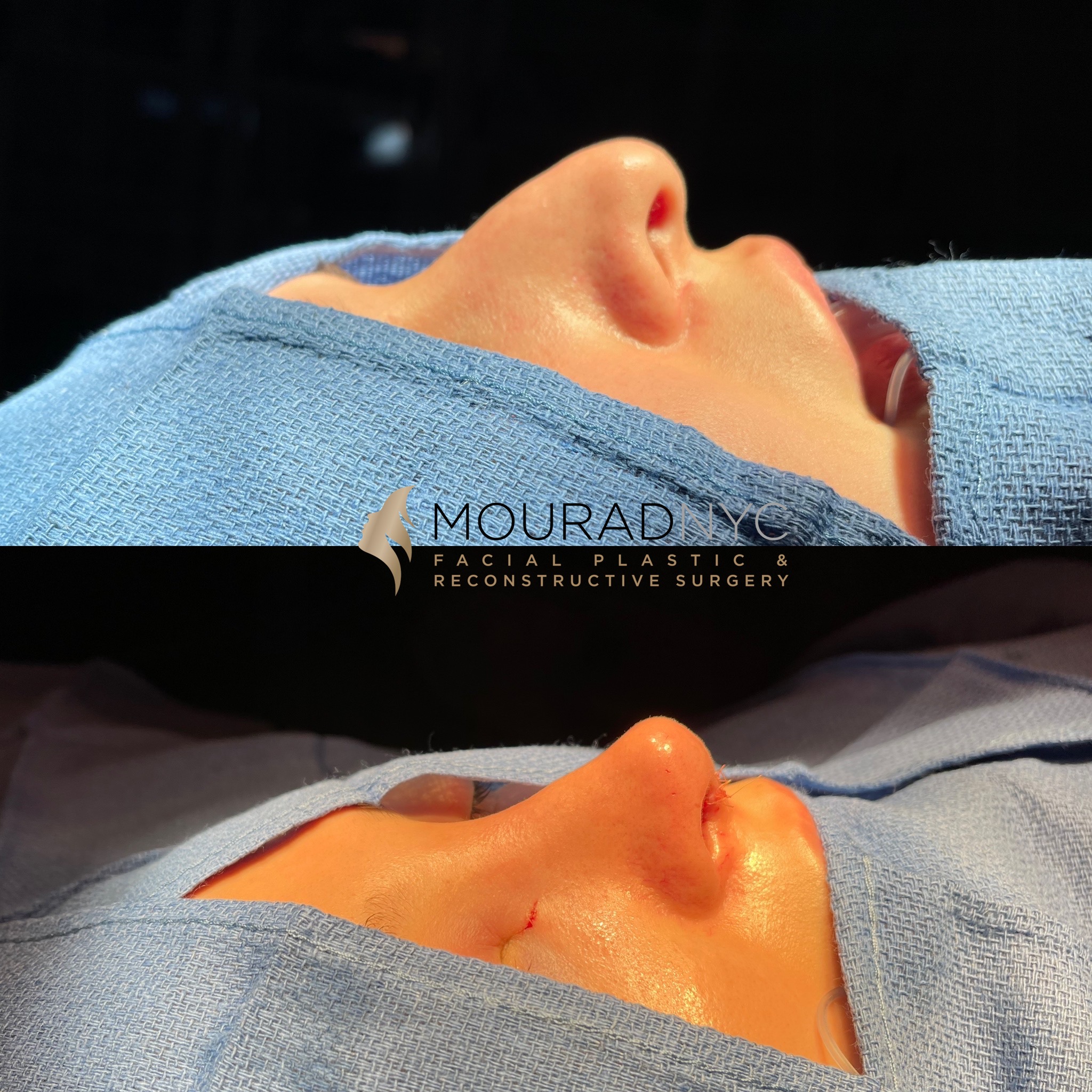 On Table 2 Rhinoplasty & Female Rhinoplasty