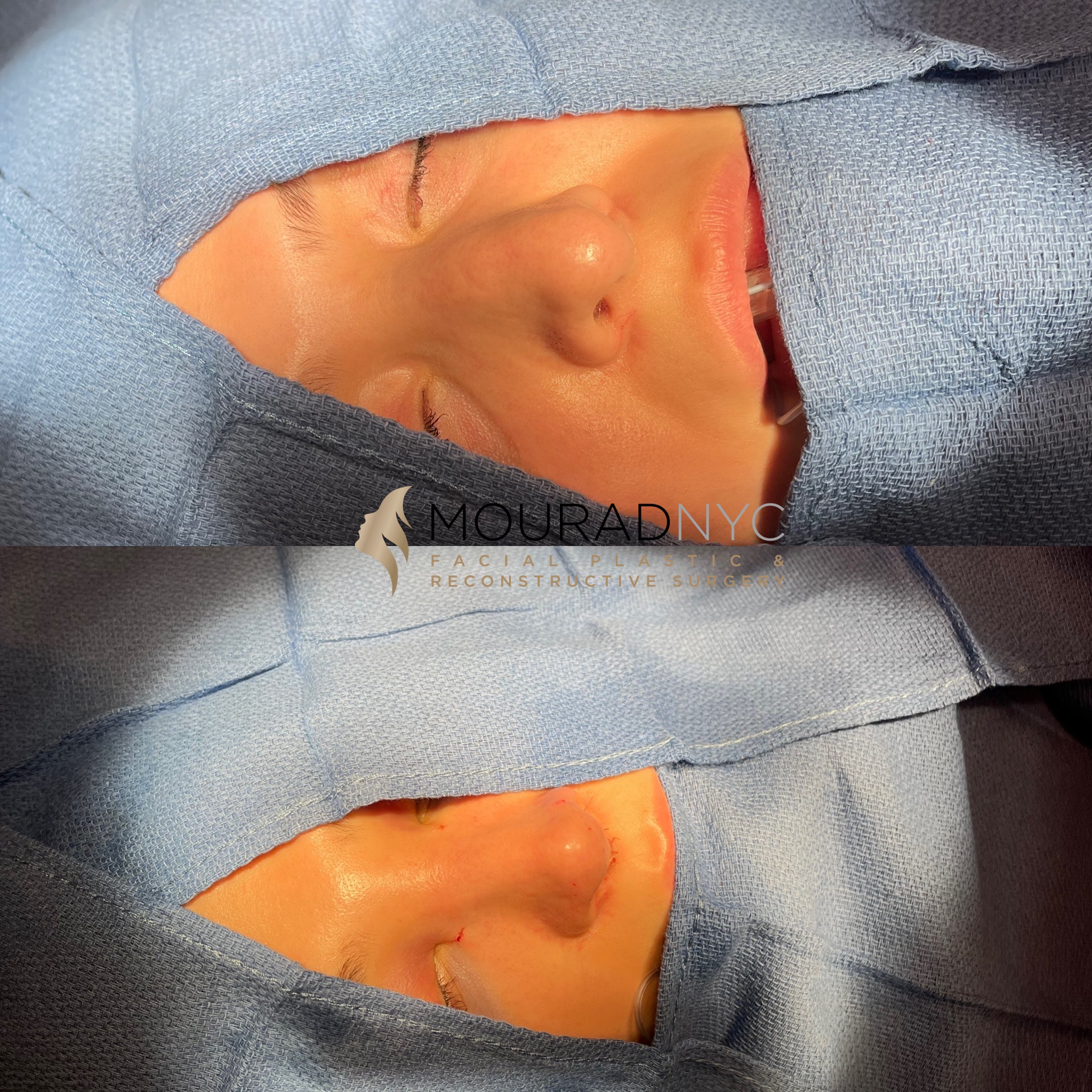 On Table 3 Rhinoplasty & Female Rhinoplasty