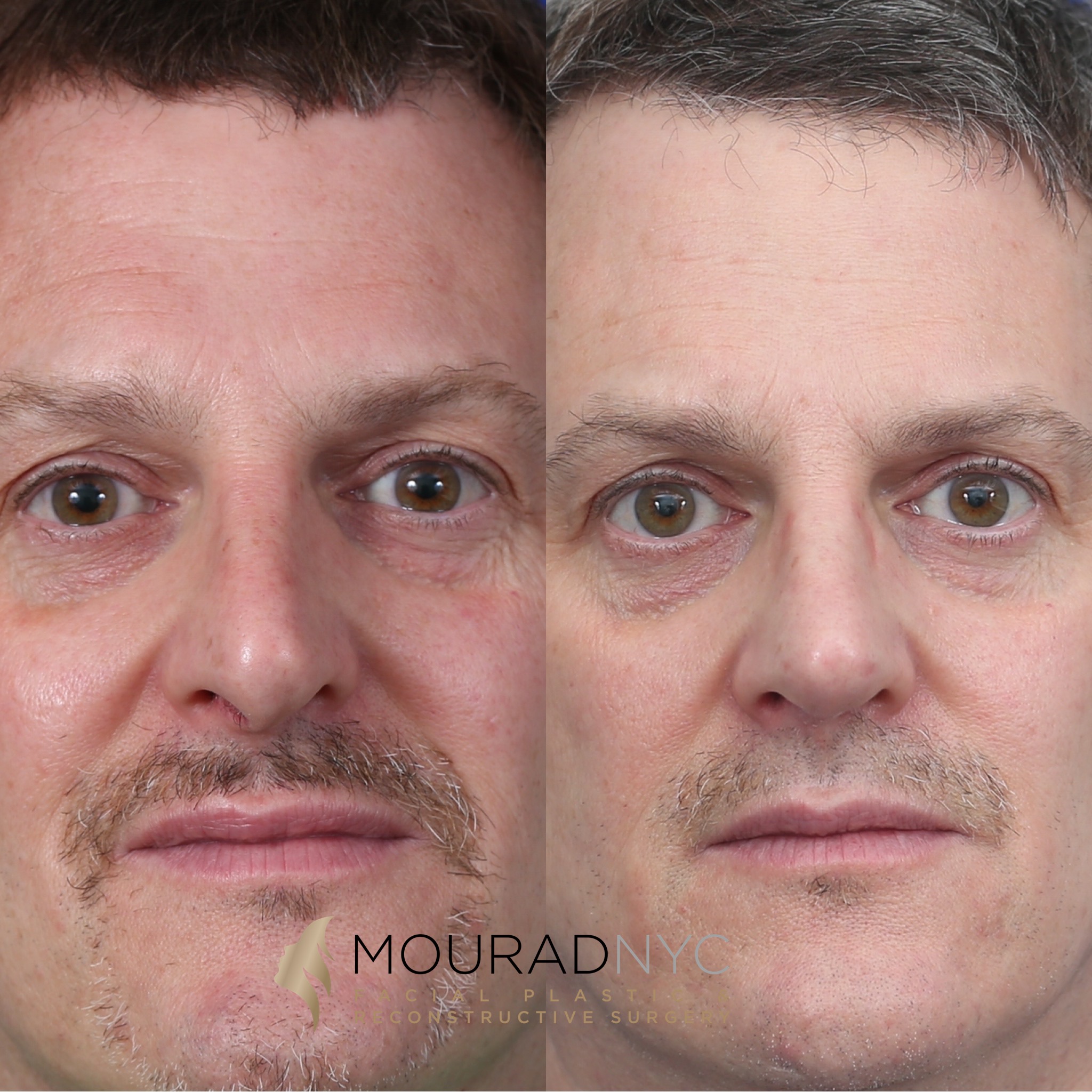 Revision1 Rhinoplasty & Male Rhinoplasty