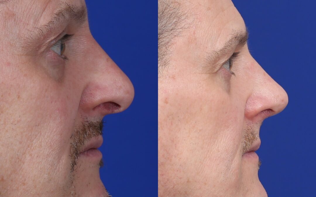 Rhinoplasty & Male Rhinoplasty