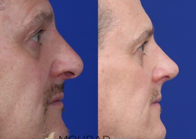 Rhinoplasty & Male Rhinoplasty