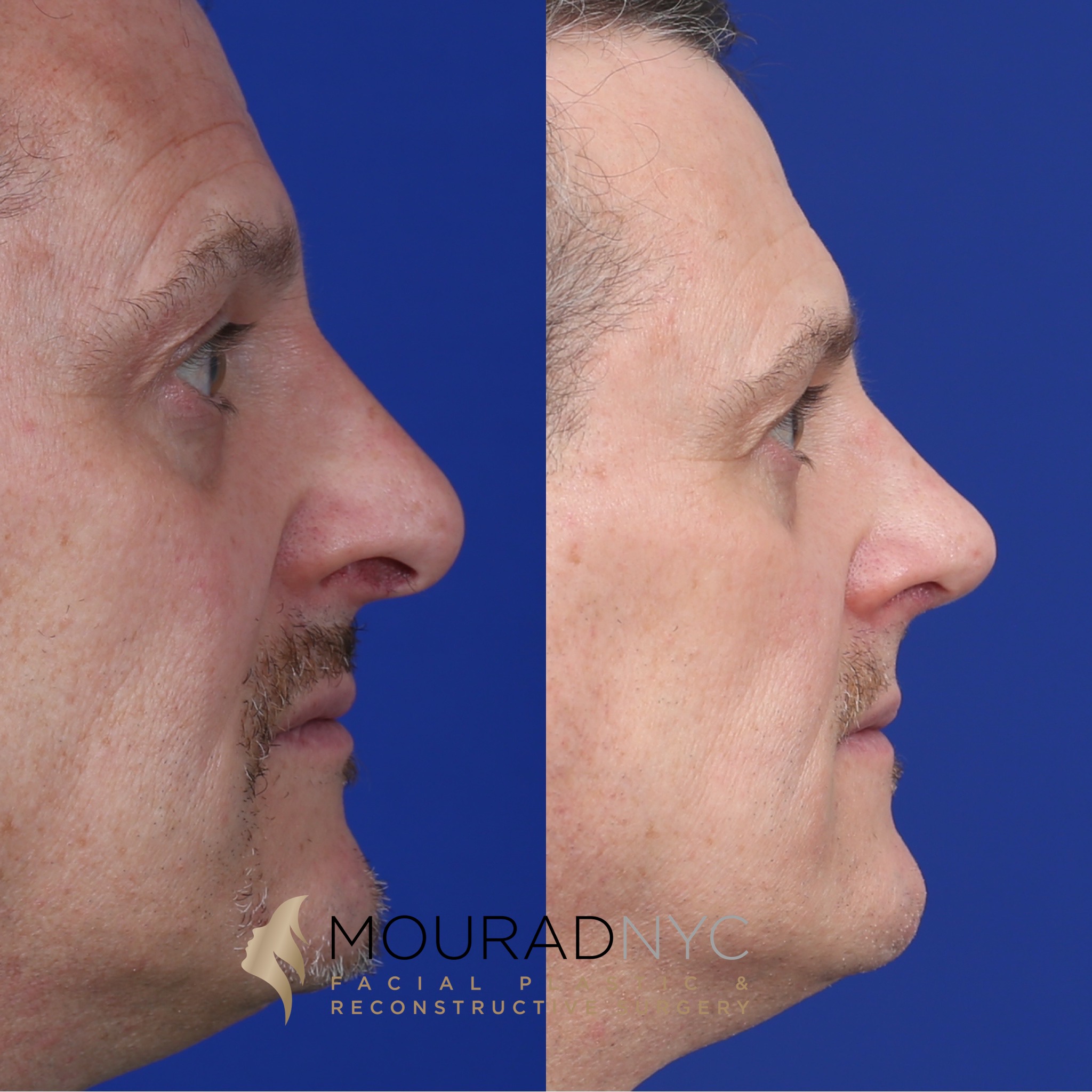 Revision2 Rhinoplasty & Male Rhinoplasty
