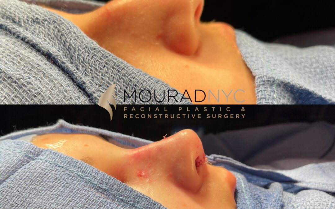 Rhinoplasty & Female Rhinoplasty
