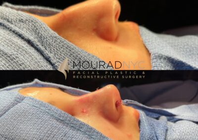 Rhinoplasty & Female Rhinoplasty