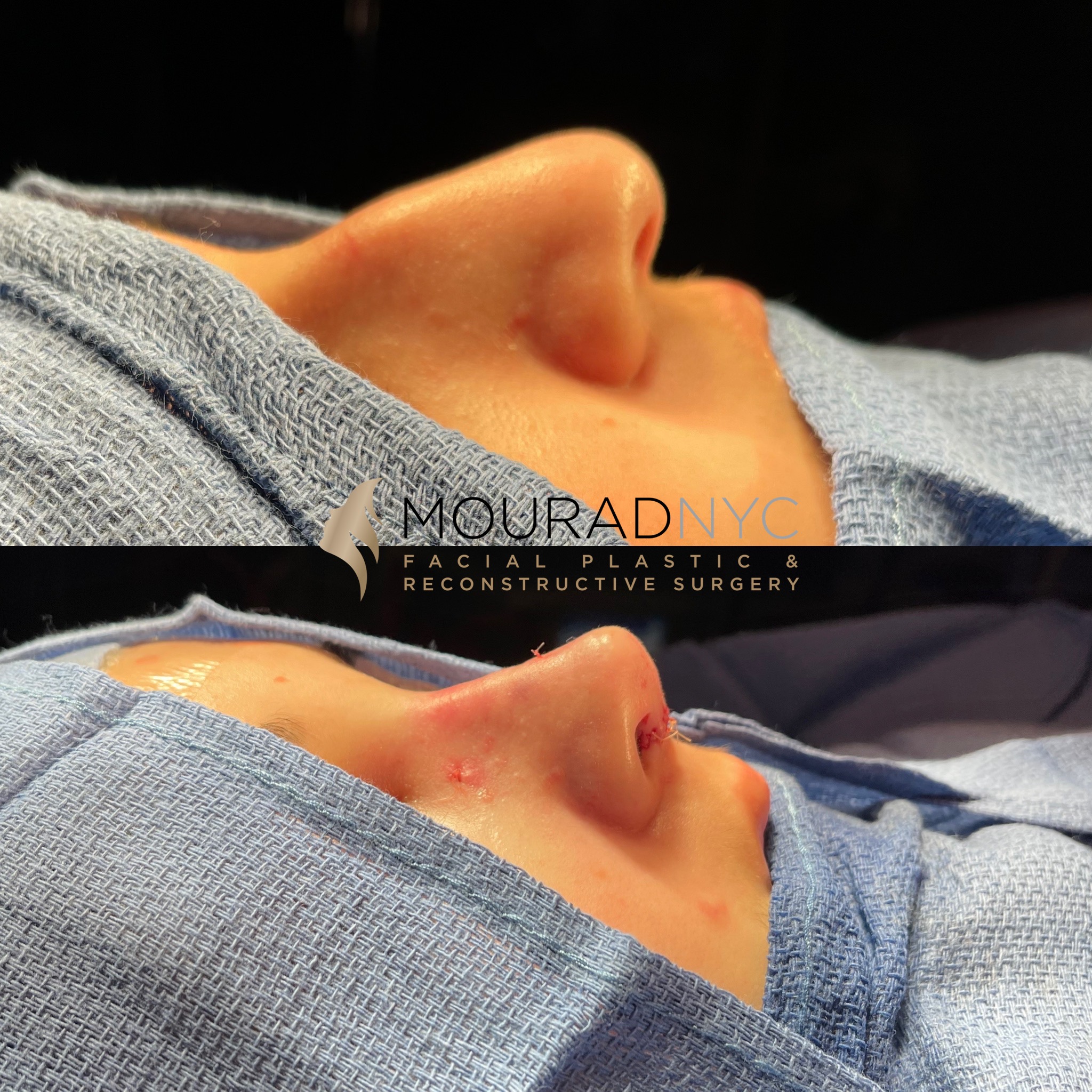 table1 (1) Rhinoplasty & Female Rhinoplasty