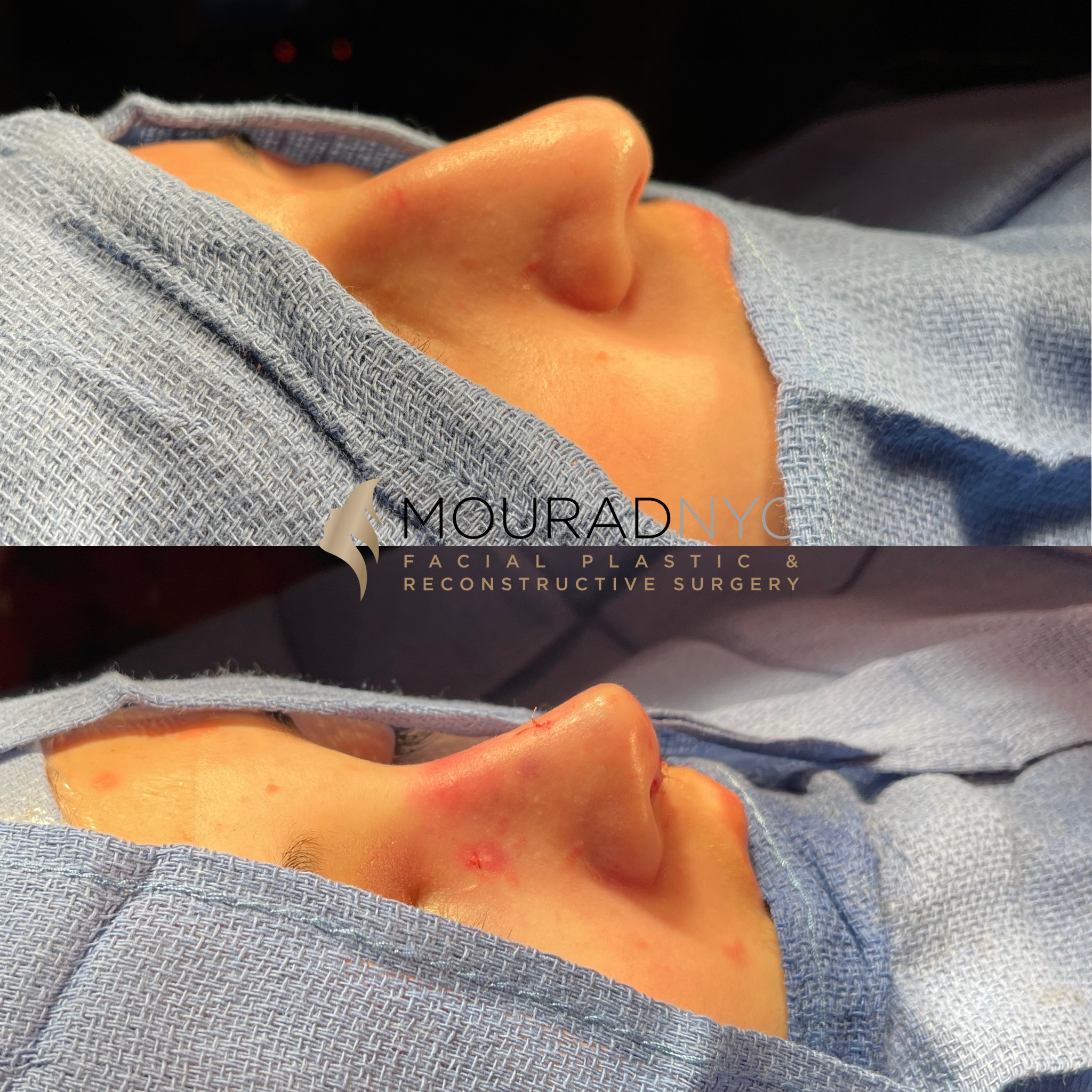 table2 (1) Rhinoplasty & Female Rhinoplasty