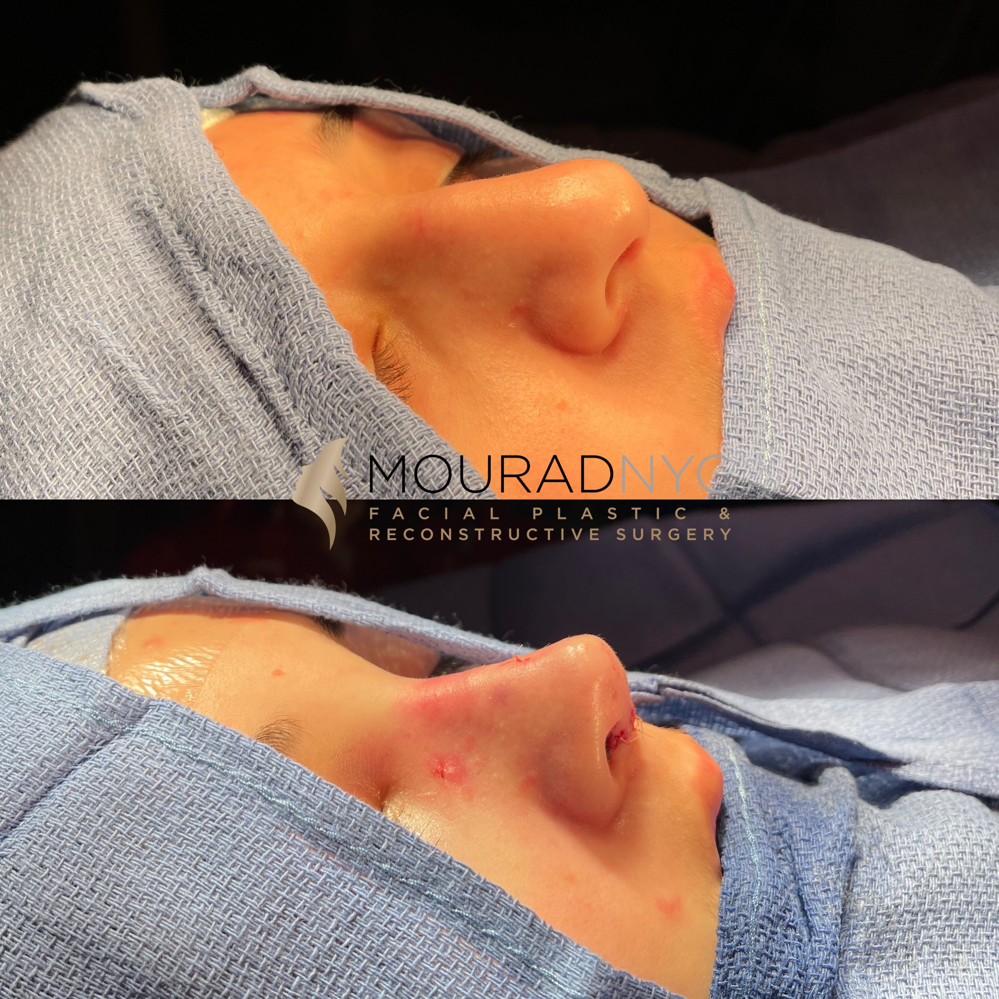 table3 (1) Rhinoplasty & Female Rhinoplasty